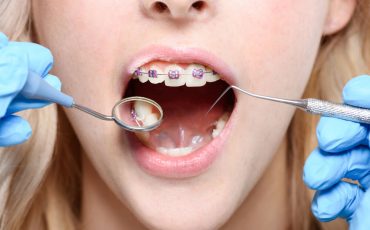 What to Do for a Toothache with Braces