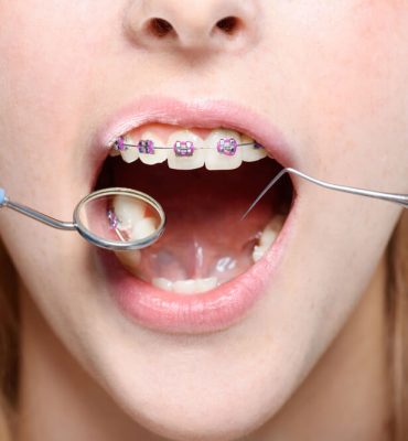 What to Do for a Toothache with Braces