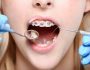 What to Do for a Toothache with Braces