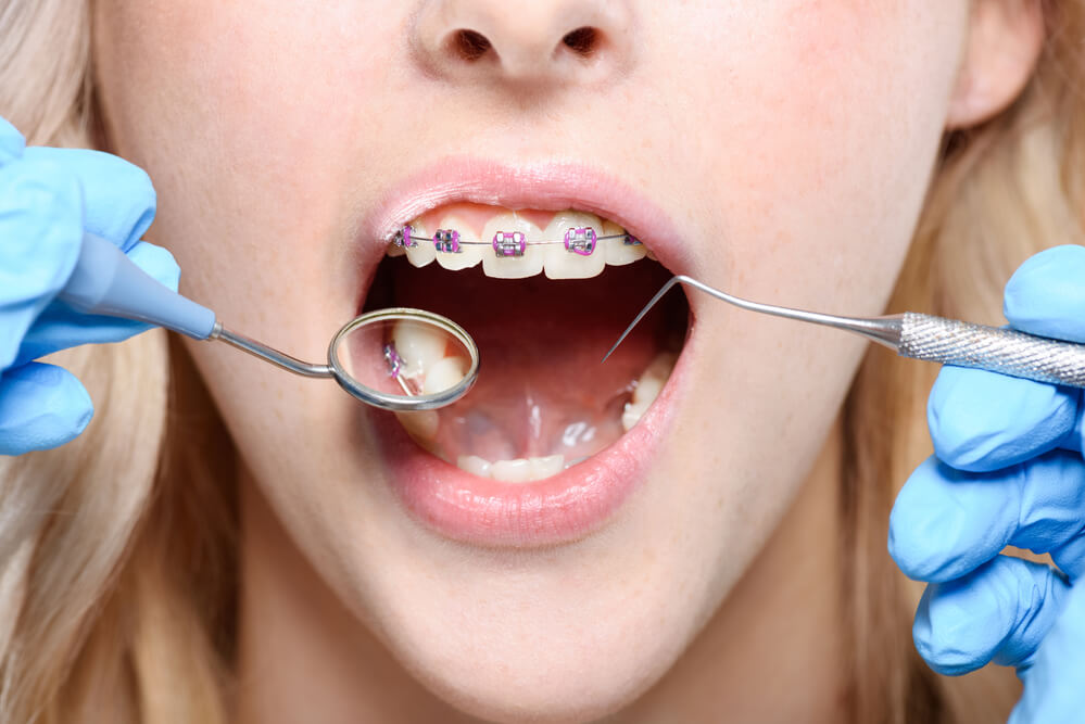 What to Do for a Toothache with Braces
